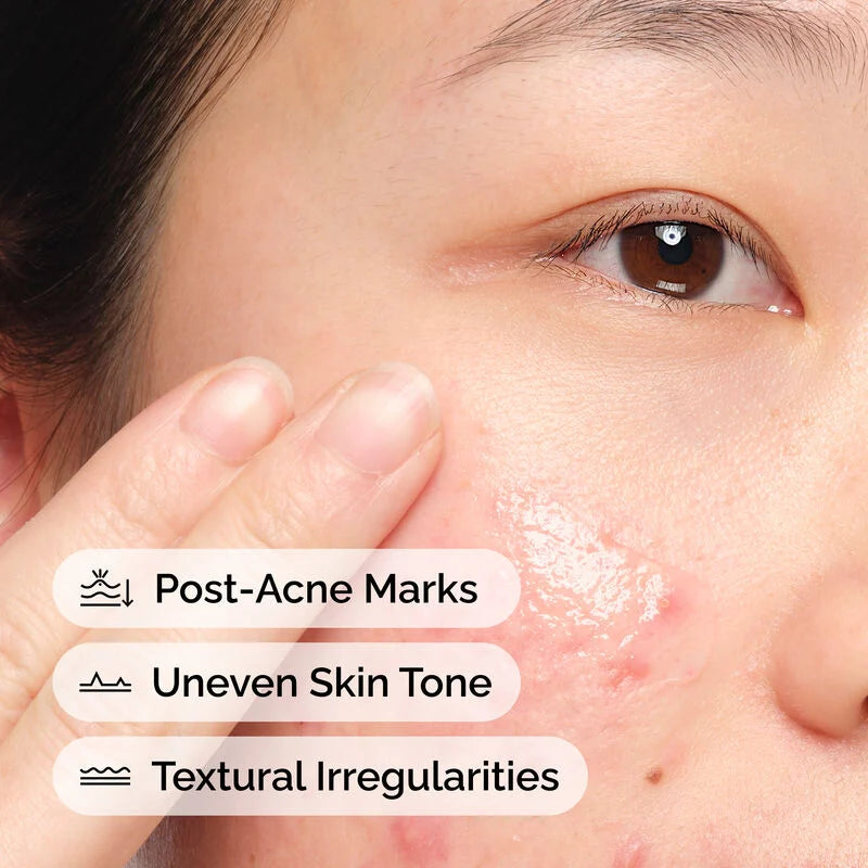The Ordinary Aloe 2% + NAG 2% Solution 30ml | Post-Acne Mark Treatment