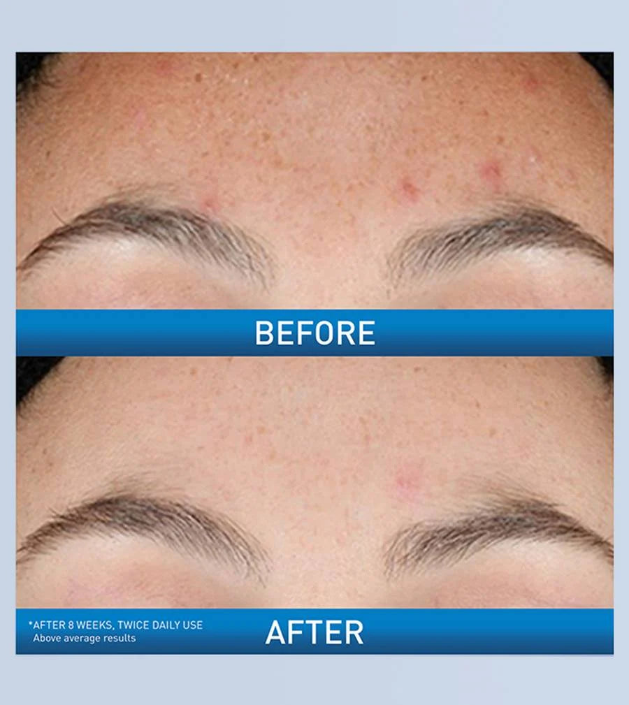 CeraVe Acne Retinol Serum 30ml for Acne Marks & Pore Refining